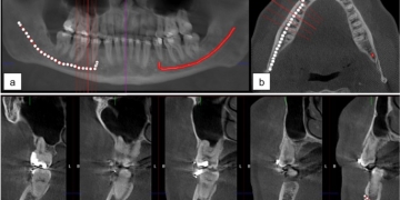 The Role of AI in Tracing the Inferior Dental Nerve (IDN) on Dental CBCT Scans