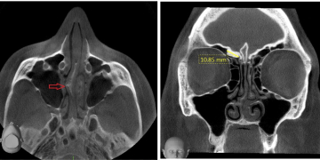 CBCT Imaging for Safer Sinus Surgery – 13 June, 2018