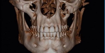 cbct scan of jaw and mouth area facing forward