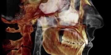 Beyond the Obvious: What Can a Dental CBCT Scan Reveal?