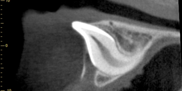 Mon 24 Jul ’17: CBCT in Orthodontics