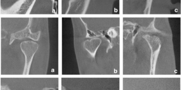 Advantages of CBCT in TMJ Assessment