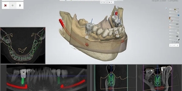 Navigating Precision: The Evolution of Guided Surgery in Dentistry