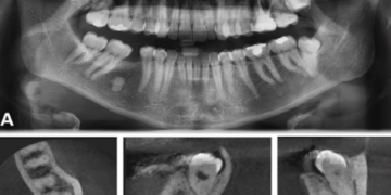 The Benefits of the Cone Beam CT Scan Over OPG for Third Molar Removal