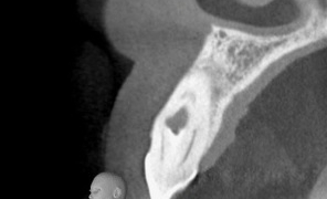 The Role of Dental CBCT Scans in Modern Root Canal Treatment