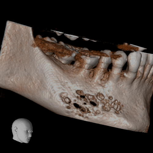 Understanding Malignant Cysts: A Dental CBCT Scan Perspective