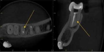 The Application of CBCT in Endodontics