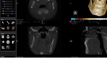 screen shot of cbct scans of a skull using the carestream software