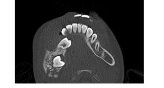 Wed 12 Jul ’17: CBCT Interpretation – Diseased anatomy and Dentoalveolar pathologies