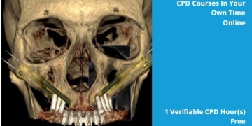 Maxillary and Zygomatic Implants for Dental Nurses