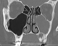 Wed 11 Oct ’17: CBCT and Odontogenic Sinusitis