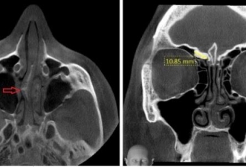 side by side image of skull sinus from different angles