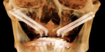 The Critical Role of CBCT Imaging in Zygomatic Implant Planning